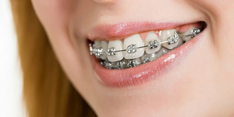 Diş Teli Kontrolleri Nasıl Yapılmalıdır?