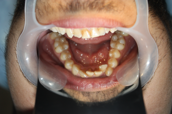ortodonti tekçene tedavisi
