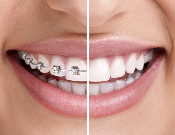 Alpdent ile Diş Teli Tedavi Adımları