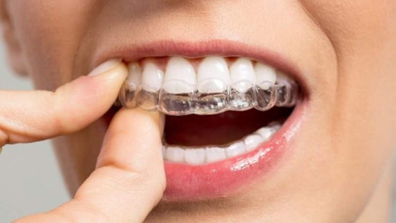 Şeffaf Diş Teli ve Şeffaf Plak Tedavisi Aynı Mıdır?