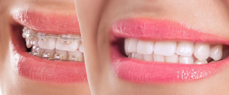 Ortodonti Tedavisinden Sonra