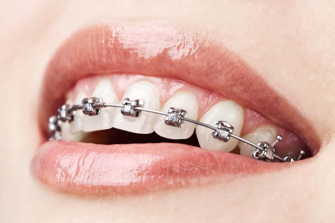 30’lu Yaşlardan Sonra Diş Teli Tedavisi