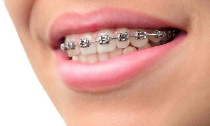 Diş Teli Tedavisinde Planlama Süreci