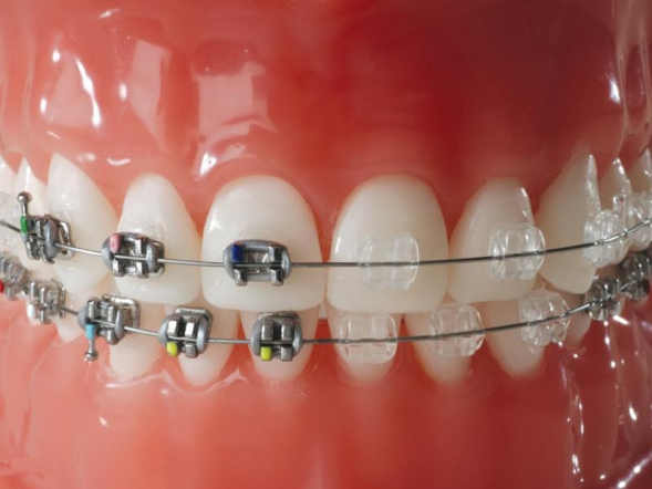 Diş Teli Tedavisinde Önemli Durumlar