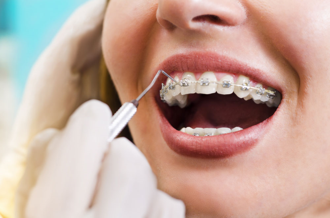 Diş Teli Çeşitleri Nasıl Seçilir?