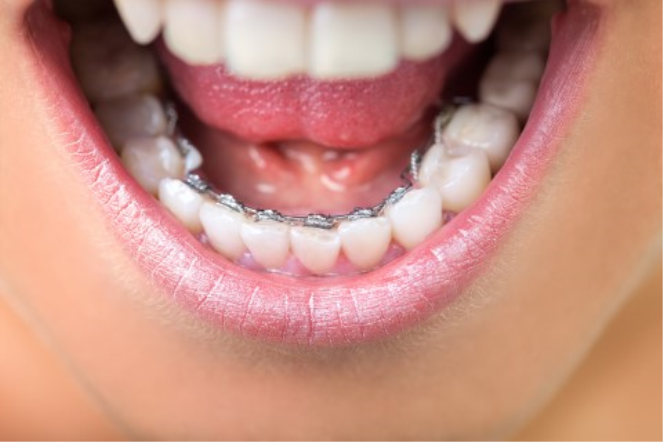 Diş Teli ile Çapraşık Dişlere Çözümler