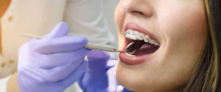 Diş Teli Sürecinde Temel Noktalar Nedir?