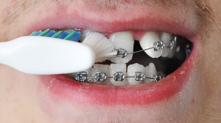 Yeterli Diş Teli Temizliği Nasıl Sağlanır?