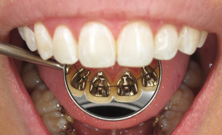 Diş Teli Tedavisini Gerektiren Etmenler