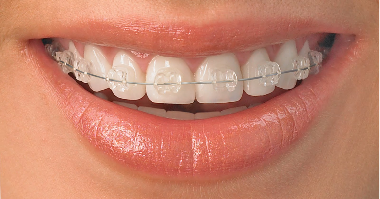 Diş Teli Tedavisi Zahmetli ve Zor Bir Tedavi Midir?