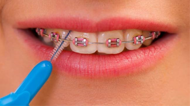 Diş Telinin Takılması Nasıl Sağlanır?