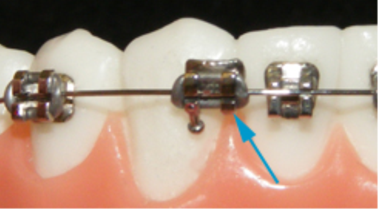 Ortodonti Tedavisinde Dikkat Edilecek Hususlar