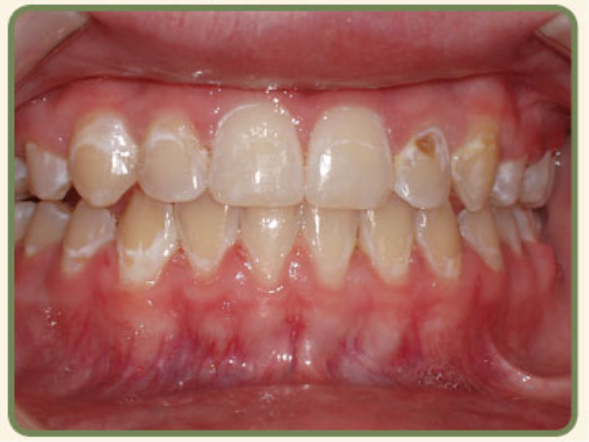 Ortodonti Tedavisinde Diş Fırçalama