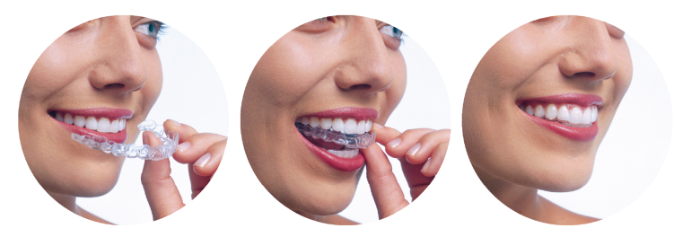 Ortodonti Tedavisinde Görünmez Diş Telinin Avantajları Nelerdir
