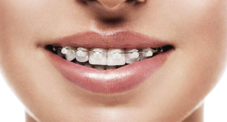 Şeffaf Diş Teli Nasıl Bir Görüntü Oluşturur?