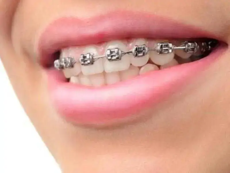 Alt Dişlere Tel Sonra Mı Takılıyor?