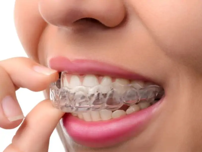 Çocuklarda ve Gençlerde Şeffaf Plak Kullanımı Uygun mu?