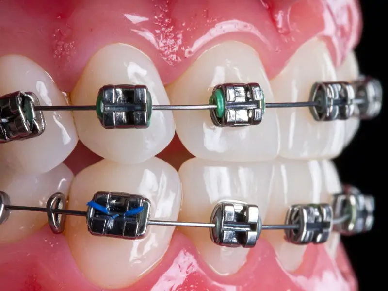 diş teli çeşitleri