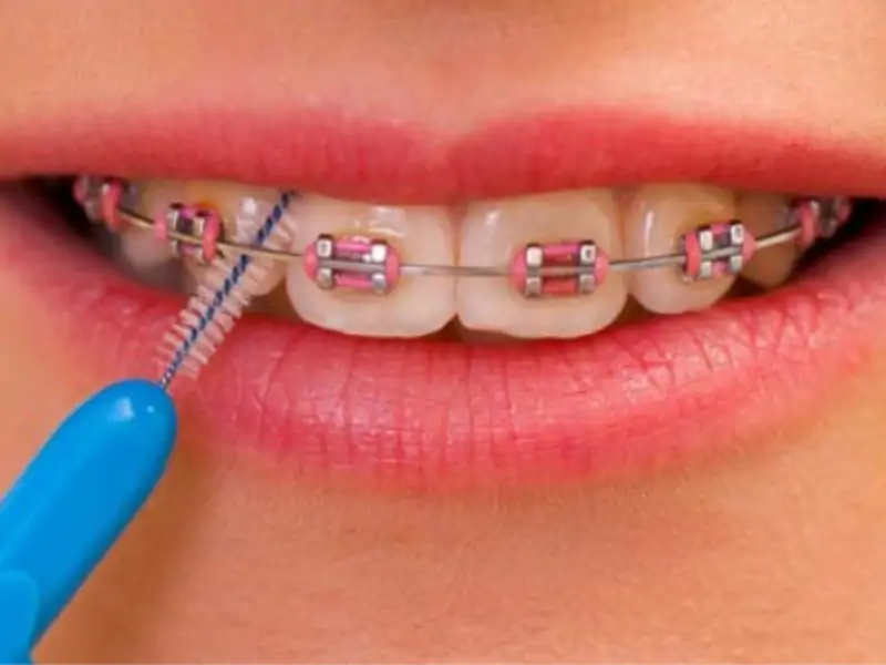 Diş Bakım Süreci ve Tedavi