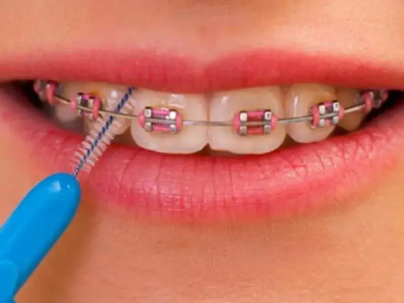 Diş Teli Acıtıyor Mu?