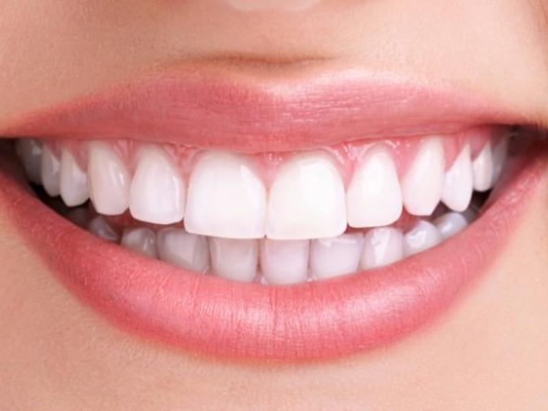 Diş Teli Çeşitleri Arasındaki Farklar Nelerdir?