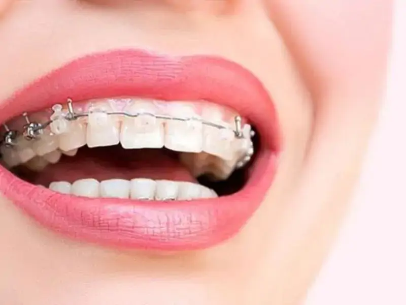 Diş teli fiyatını devlet karşılıyor mu