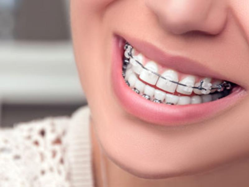 Diş Teli Fiyatları 2019 Yılında Ne Kadardır?