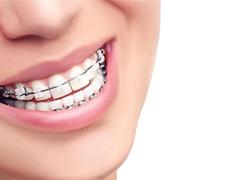 Diş Teli Fiyatları 2020 Düzenlemeleri Nasıl Yapılır?