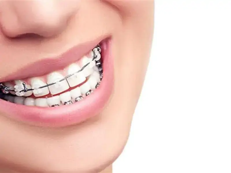 Diş Teli Fiyatları 2020 Düzenlemeleri Nasıl Yapılır?