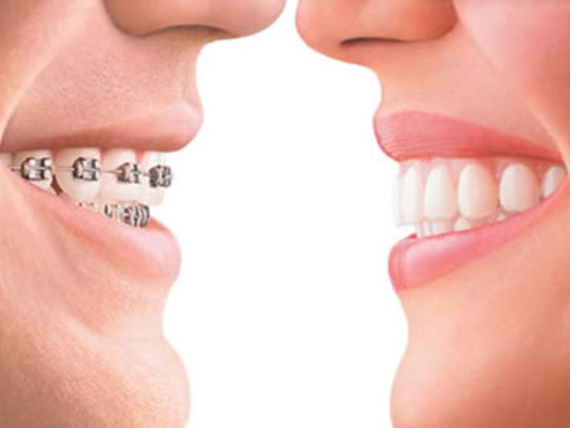 Diş Teli Fiyatları 2020 Yılında Ne Kadar?