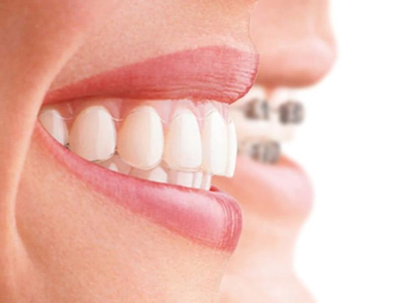 Diş Teli Fiyatları Süreci Etkiler Mi?