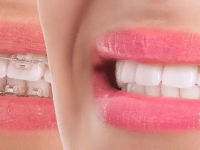 Diş Teli Fiyatları ve Tedavi