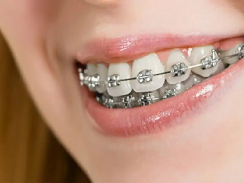 Diş Teli Kaç Ayda Bir Sıkılır?