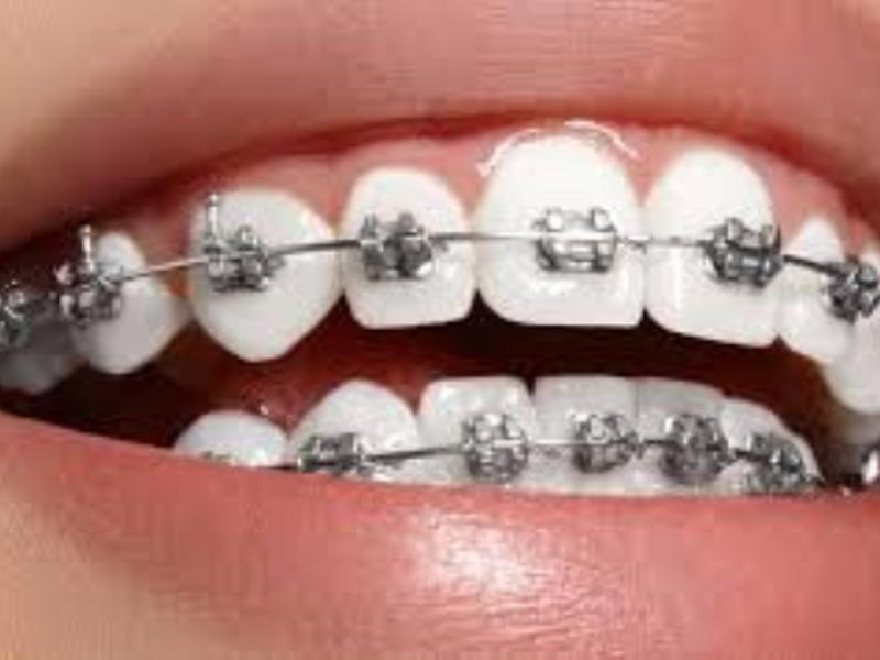 Diş Teli Kullanımı Neden Gereklidir ve Her Yaşta Yapılabilir mi?