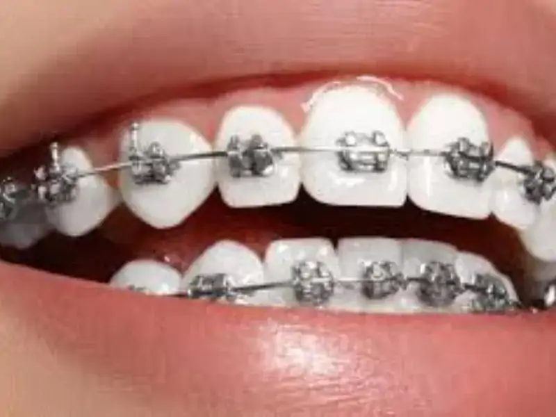 Diş Teli Kullanımı Neden Gereklidir ve Her Yaşta Yapılabilir mi?