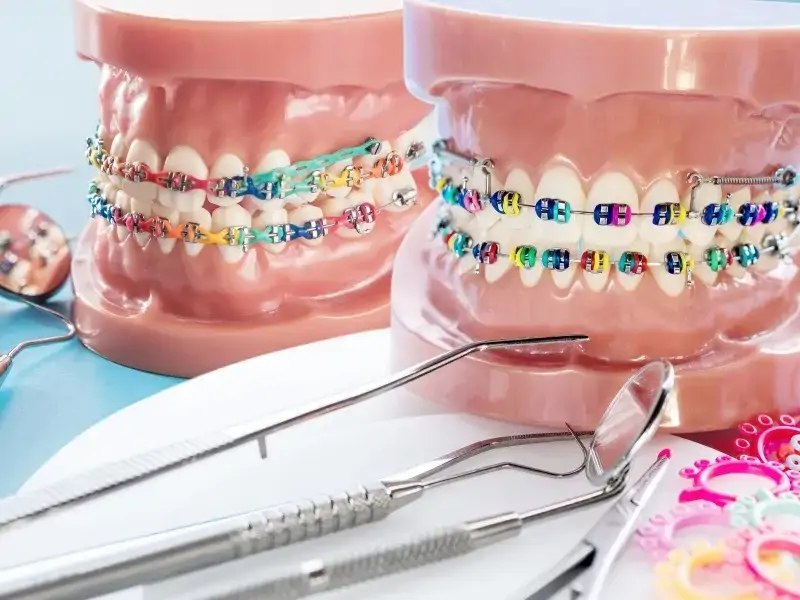 Diş Teli Nasıl Çıkarılır?