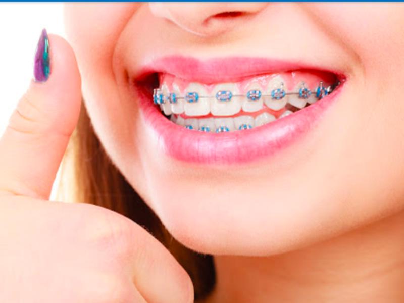 Diş Teli Nasıl Takılabilir?