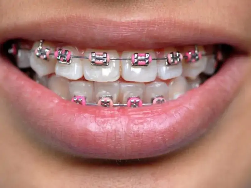 Diş Teli Nasıl Takılır