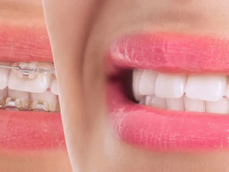 Diş Teli Ne Kadar Süre Takılı Kalır?