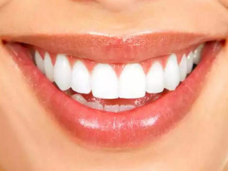 Diş Teli Sürecinde Önemli Olan Noktalar