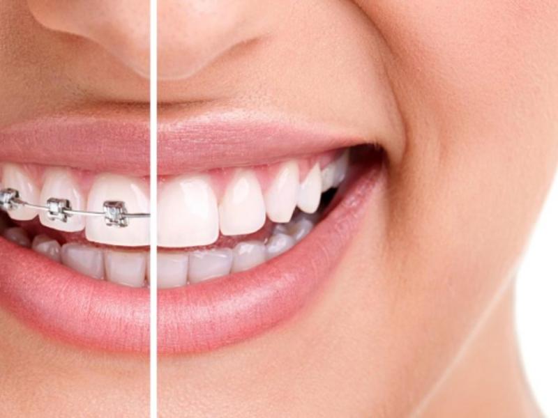 Diş Teli Tedavi Süreci