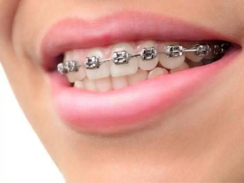 Diş Teli Tedavisi Yara Yapar Mı?