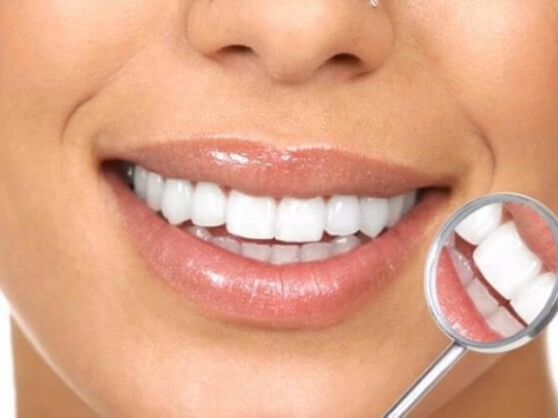 Diş Teli Tedavisinde Bilinmesi Gerekenler Nedir?