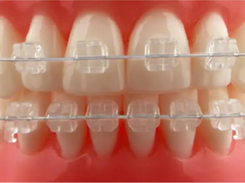 Diş Teli Tedavisinde Braket Seçimi