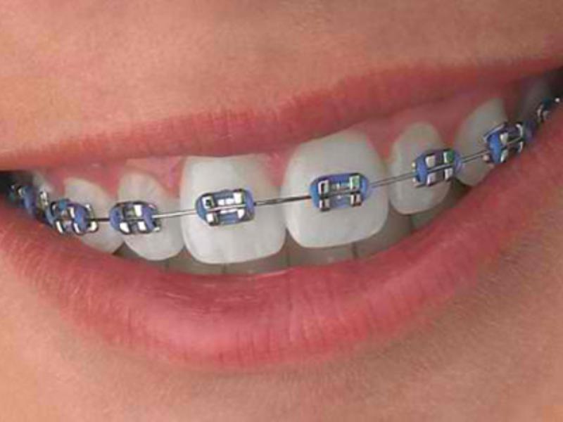 Diş Teli Tedavisinde Braket Seçimine Dikkat Edilecek Noktalar