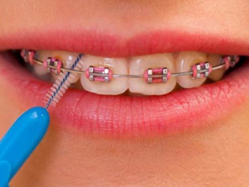 Diş Teli Tedavisinde Diş Dolgusu Yapılır Mı?