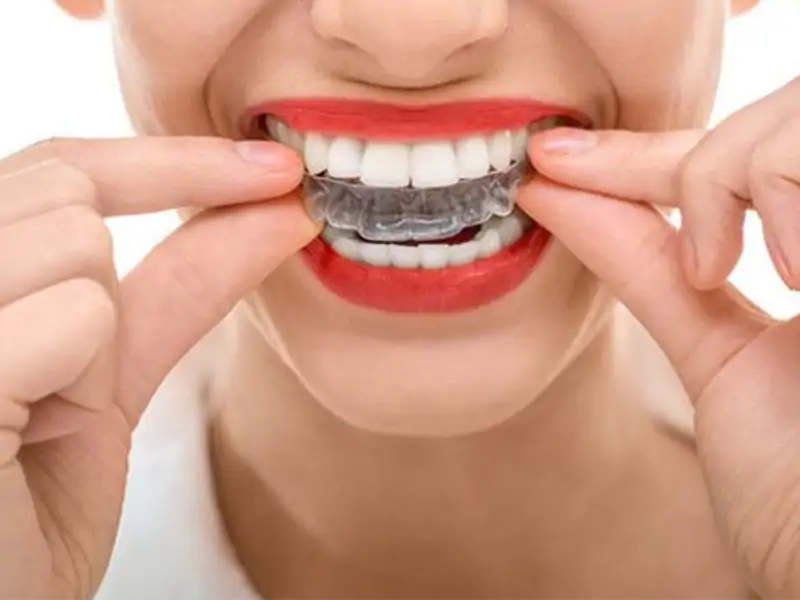 Diş Teli Tedavisinde Önemli Durumlar