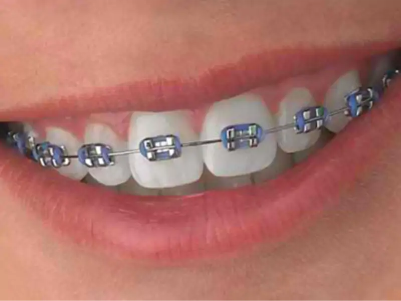 Diş Teli Tedavisinde Rutin Noktalar