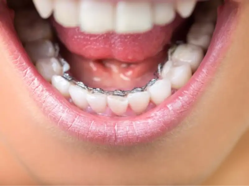 Diş Teli Tedavisinde Yay Kullanımı