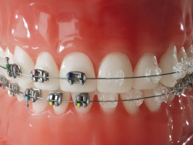 Diş Teli Türlerinin Tedavi Sürecindeki Rolü